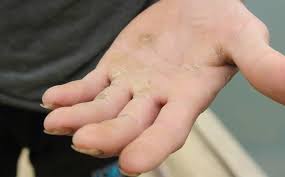 Chai da tay chân - Hình ảnh minh họa